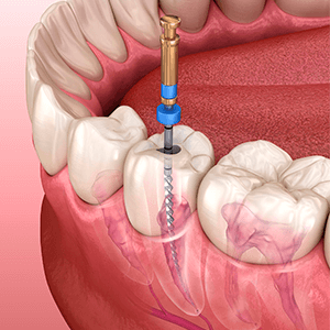 Endodoncia